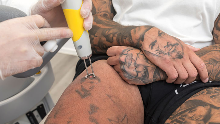 mike anderson laser tattoo removal clinic think again